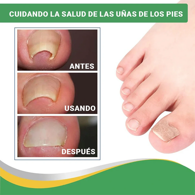 (PIDE 10 y LLEVA 20) Encravax - Parches Para Hongos y Uñas Encarnadas - QuieroMás Magazine