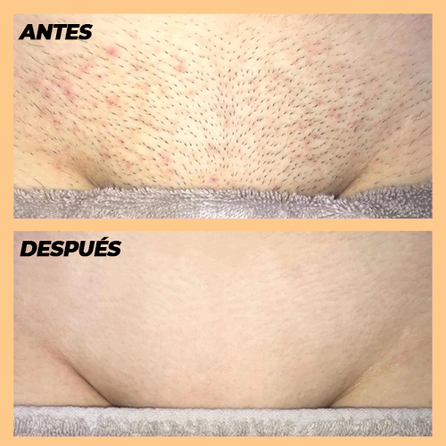 FULL EPILATOR PRO™ - DEPILADORA LÁSER PIEL PERFECTA - QuieroMás Magazine