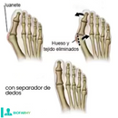 Separadores de dedos BioFarmy® | Sin dolores de pies ni de espalda [COMPRE 1 LLEVE 2 PARES] - QuieroMás Magazine